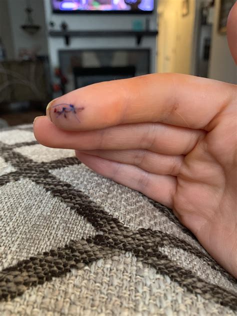 The result of broken cover slip glass. Went all the way to the bone