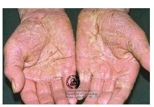 Person with Eczema skin disease. | Download Scientific Diagram
