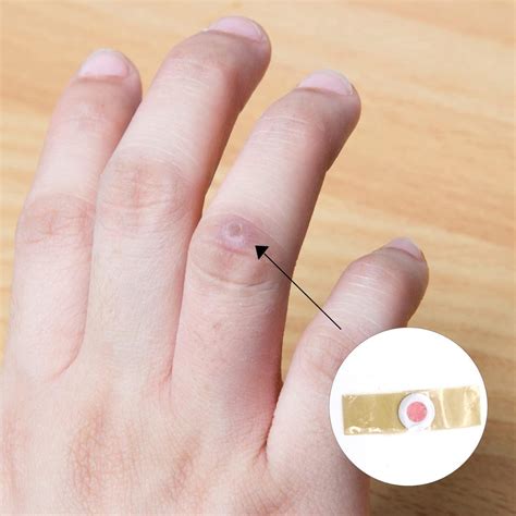 Corn Remover Pads - 10 Pcs Corn & Wart Removal Plasters for Feet - Anti