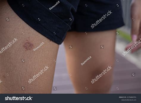 Fungal Lesions On Legs Portraits Skin Stock Photo 2176884791 | Shutterstock