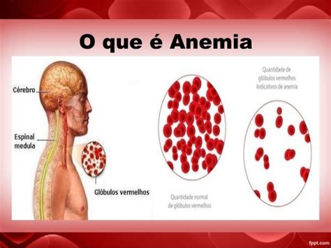 O'que A Anemia Pode Causar - Anemia: Como prevenir e tratar através da alimentação