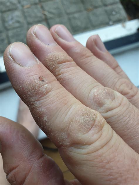 [Skin Concerns] Dry cracked skin on sides/knuckles : r/SkincareAddiction