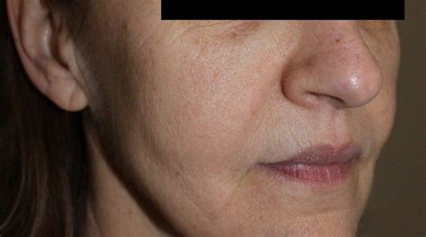 Full Face Lift – Wowmen Skin Laser and Cosmetic Clinic in Hyderabad