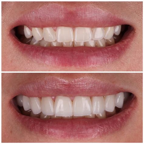 No Prep Veneers - Austin Artistic Dental | #1 Cosmetic Dentist in Austin