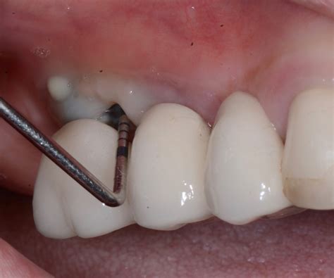 Peri-implantitis: Prevent, Recognize & Treat - ITI Blog