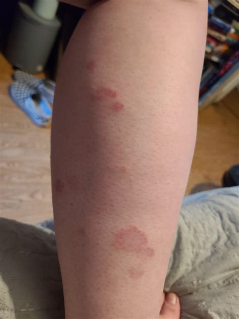 Rash On The Side Of My Thigh at Shawana Salvatore blog
