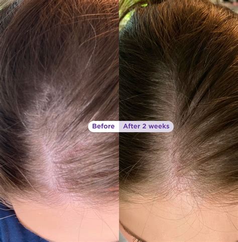 Scalp Revitalizing Solution Miracle in Shower Treatment - Dr. Groot