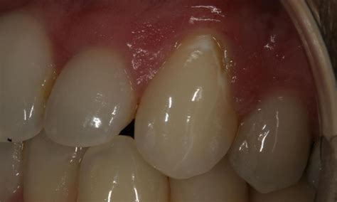 's Smile Gallery | Composite Resin Filling