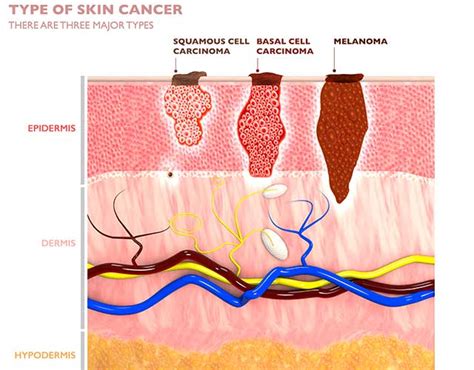 Squamous Cell Carcinoma Overview | Moffitt
