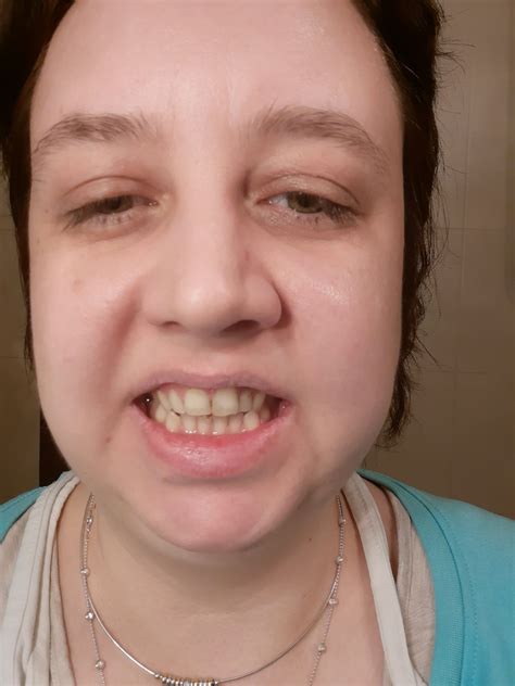 Do my teeth still look decent? - Health and Recovery - Schizophrenia.com