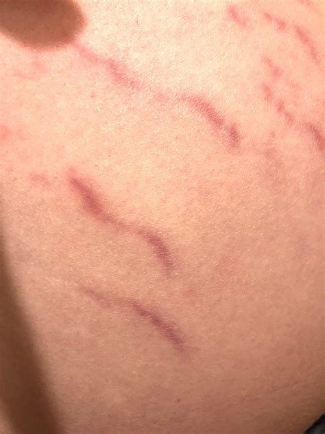 What could these red lines on my skin be? Been over a month and hasn’t