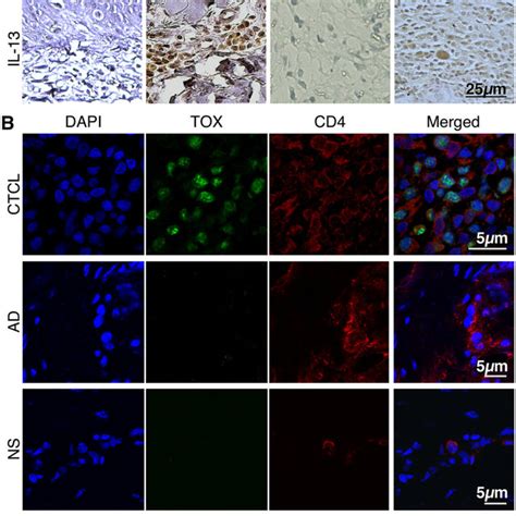 il  receptors  expressed  tumor cells   skin lesions