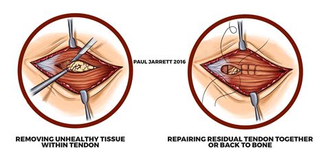 Elbow Tendonitis Medial Epicondylitis Treatment at Alica Darbyshire blog