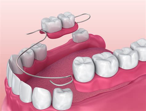 Partial Dentures in Doylestown, PA - Bucks County - Artistic ...
