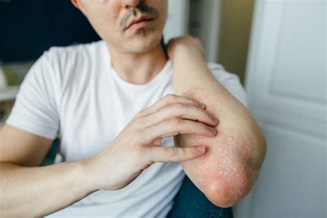 Guidelines on Atopic Eczema Provide Treatment Recommendations for ...