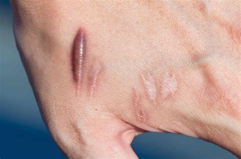 Keloid,Scar,(hypertrophic,Scar),On,Man,Hand,Skin,After,Accident ...