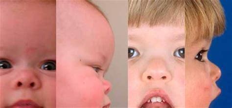 Carpenter syndrome: MedlinePlus Genetics