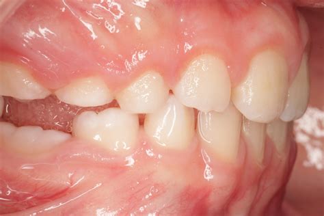 'Why doesn't a tooth come out completely?': Dental Ankylosis - Vélez