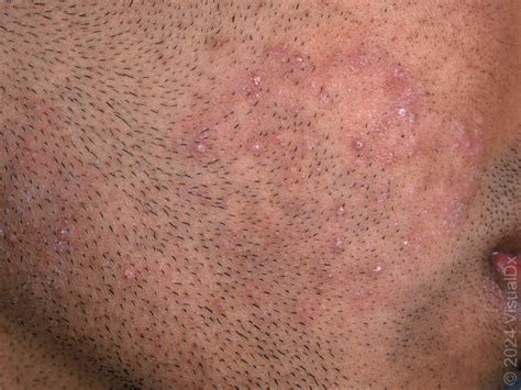 fig  tinea barbae courtesy  visualdx dermalive