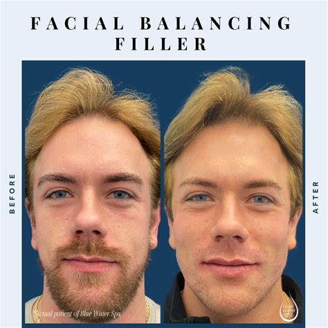 Facial Balancing | Raleigh NC