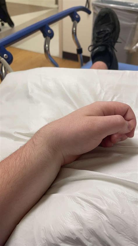 Recently Fractured Left Radius : r/XRayPorn
