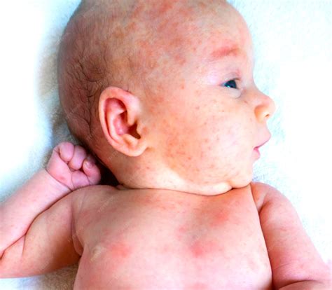 Premium Photo | Baby allergy skin food child dermatitis symptom problem