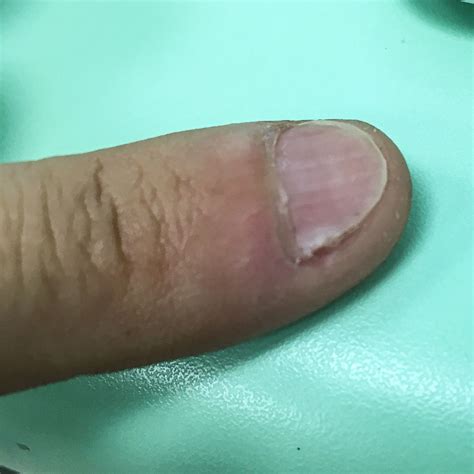 Uña deformada por una verruga – dermatologo.net