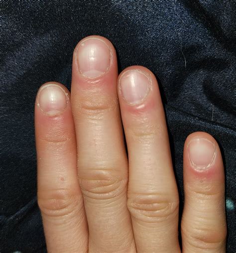 my cuticles are always swollen like this. can it be a sign of something