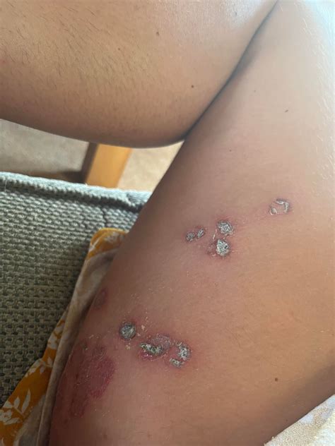 Unexplained spreading blisters on arms and legs : r/DermatologyQuestions