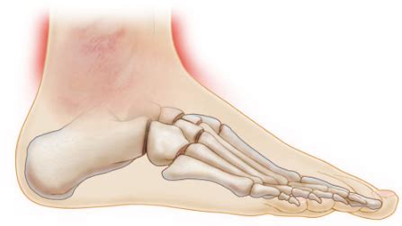 Causes of Pain in Ankle