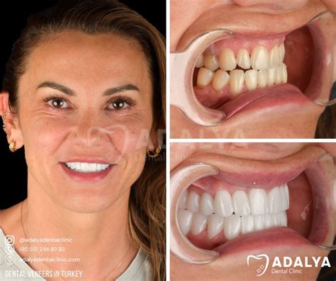 Turkey Teeth Veneers Before and After | Adalya Dental Clinic