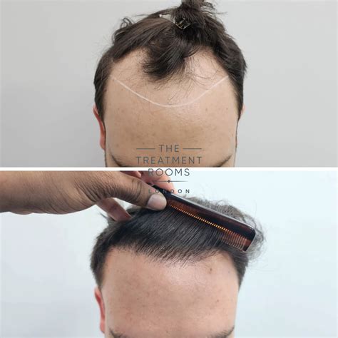 receding hairline hair transplant 1