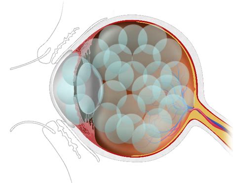 The Truth Behind the 27 Contact Lenses Stuck in the Patient's Eye ...