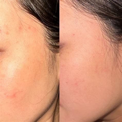 248 best Azelaic Acid images on Pholder | Skincare Addiction, Tretinoin