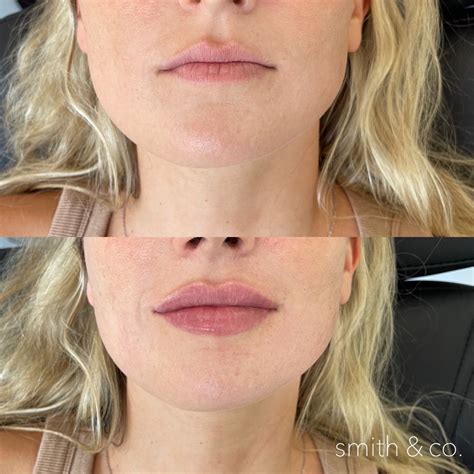 Natural lip fillers | Natural lips, Botox lips, Lips inspiration