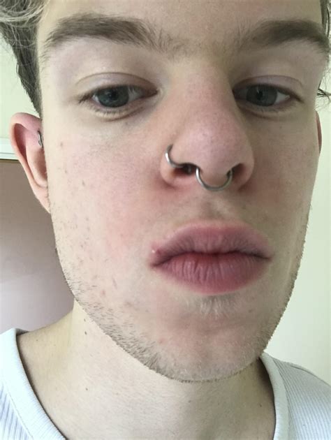 lip pimple is so fucking painful i can’t stand it. picture is the