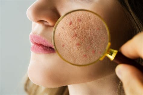 acne types   prevention professional acne care