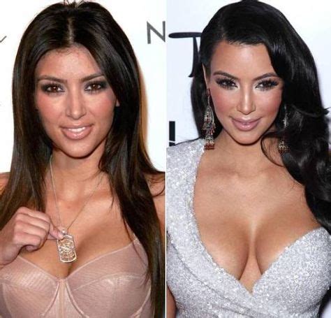 The Truth Behind Kim Kardashian Surgery: What You Need to Know