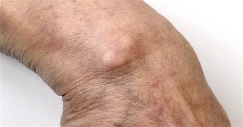 ganglion cyst   lump filled  liquid    joints
