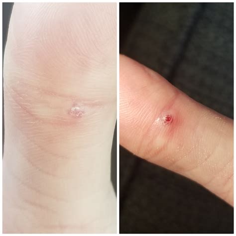 White Spots On Blood Blister at Claire Sidaway blog