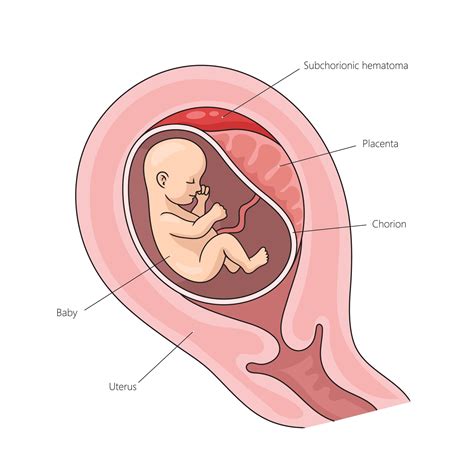 What Causes Placental Abruption? Placental Abruption Causes - Placental