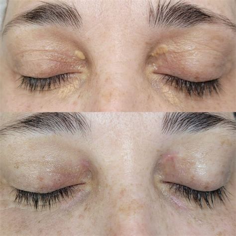 Jato de Plasma Tratamento - Erica Stefano