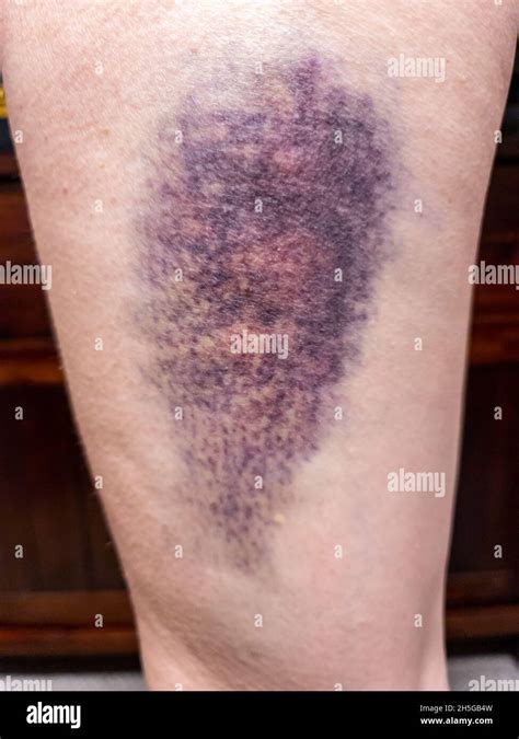 Large coloured bruise damage on upper leg. Hematoma Stock Photo - Alamy