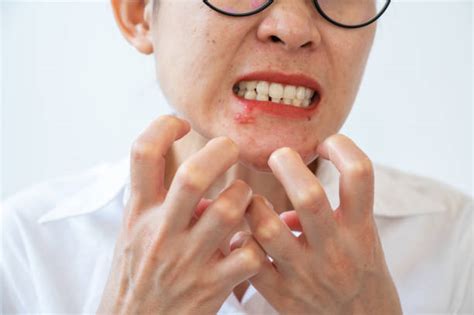 Strep Rash Stock Photos, Pictures & Royalty-Free Images - iStock