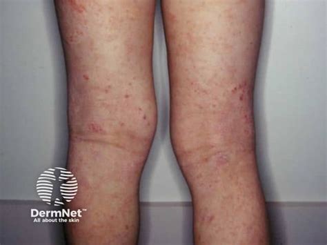 Atopic flexural eczema images