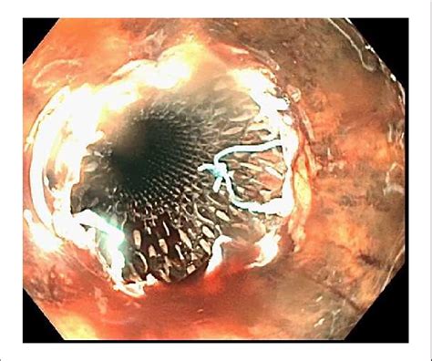 Endoscopic view of the fully covered stent placed in the esophagus