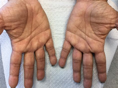 Pitted Keratolysis Hands