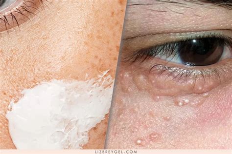 understand remove  prevent whiteheads lizbreygel beauty