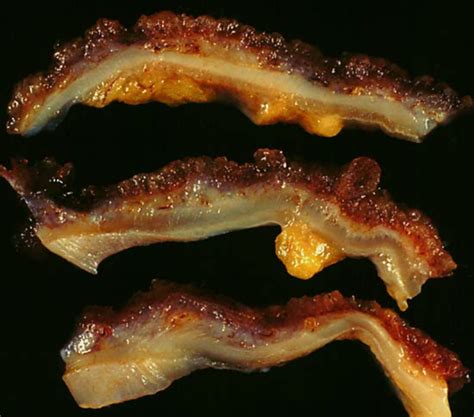 Colitis ulcerosa (2) - DocCheck