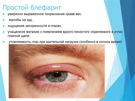 Заболевания век - презентация онлайн